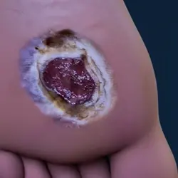 open wound type: Diabetic foot ulcers