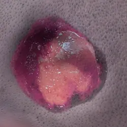 open wound type: Surgical dehiscence